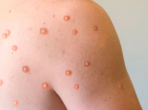 Viruela símica: detectaron en Argentina el primer caso de una variante asociada a mayor severidad